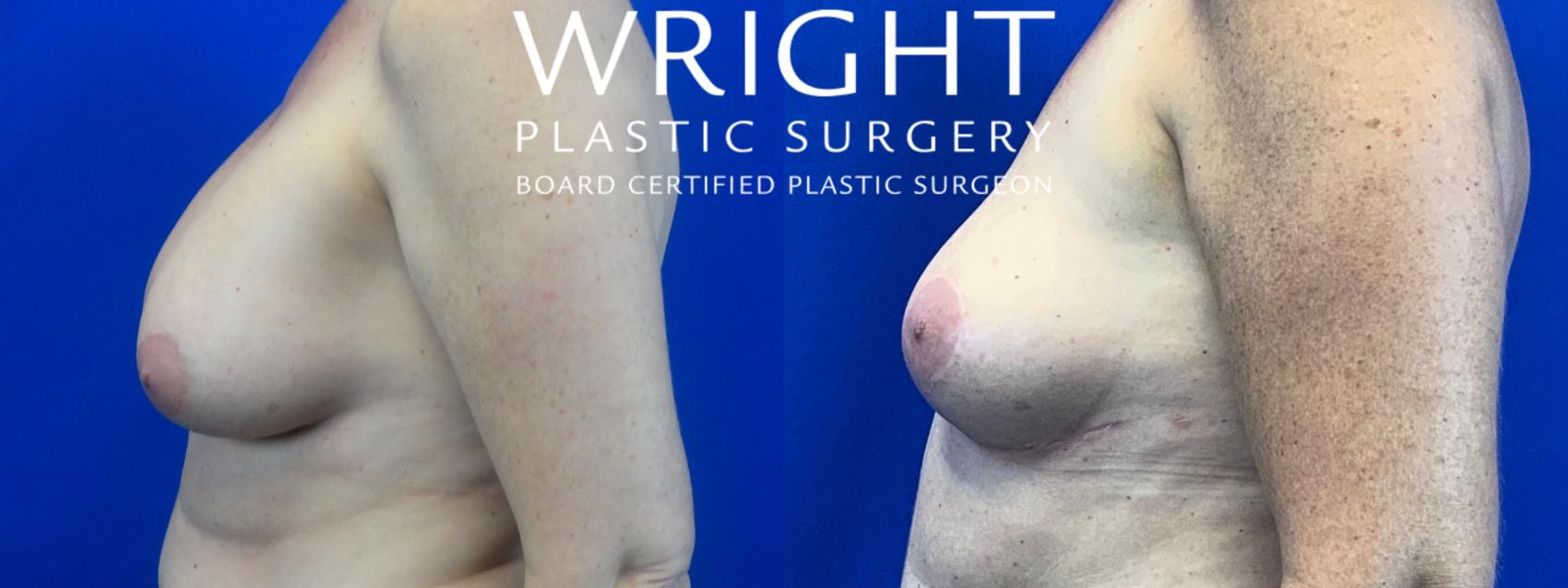 Before & After Breast Implant Removal Case 43 Left Side View in Little Rock, Arkansas