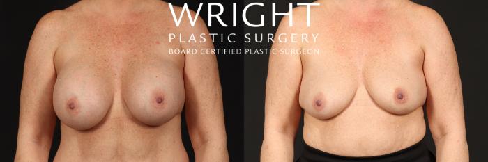 Before & After Breast Implant Removal Case 439 Front View in Little Rock, Arkansas