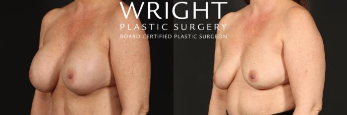 Before & After Breast Implant Removal Case 439 Left Oblique View in Little Rock, Arkansas