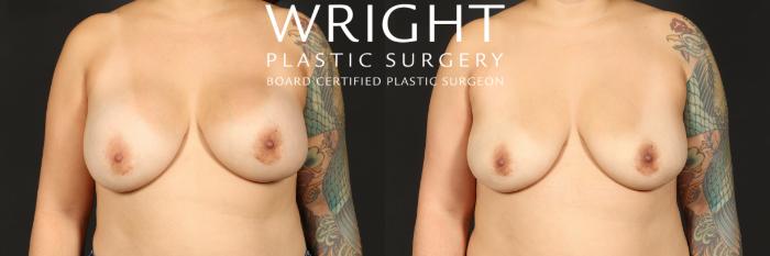 Before & After Breast Implant Removal Case 442 Front View in Little Rock, Arkansas
