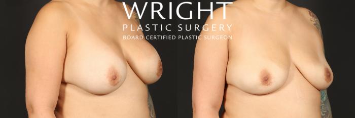 Before & After Breast Implant Removal Case 442 Right Oblique View in Little Rock, Arkansas