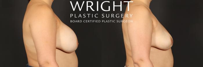 Before & After Breast Implant Removal Case 442 Right Side View in Little Rock, Arkansas