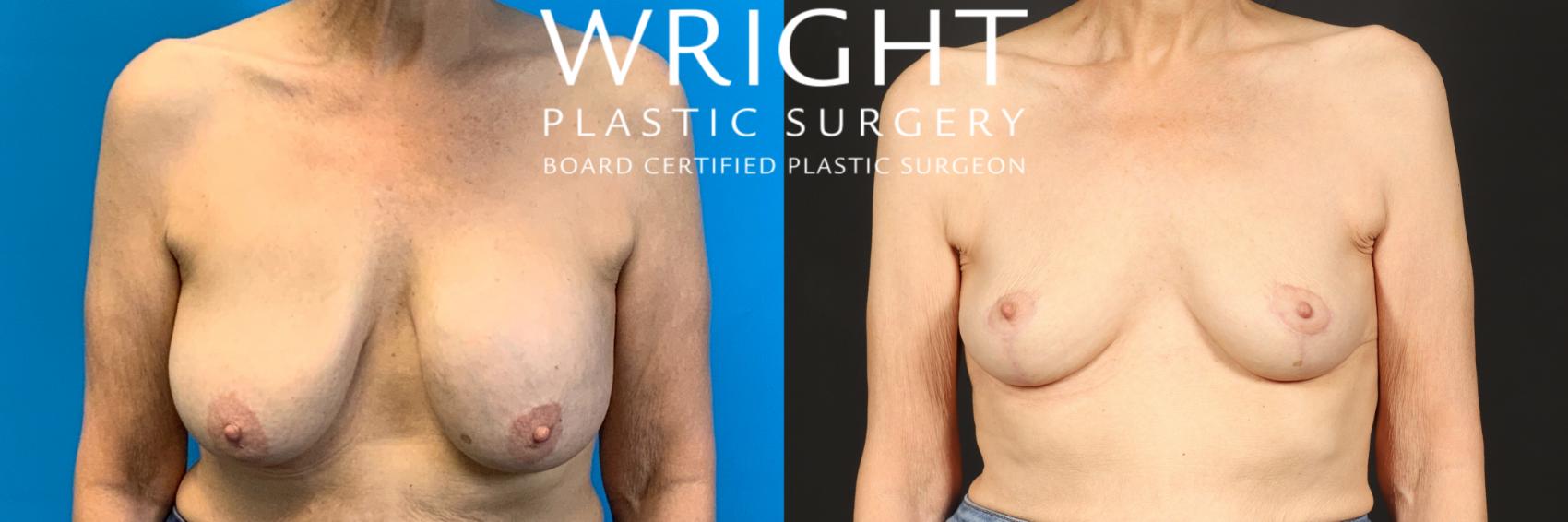 Before & After Breast Implant Removal Case 445 Front View in Little Rock, Arkansas