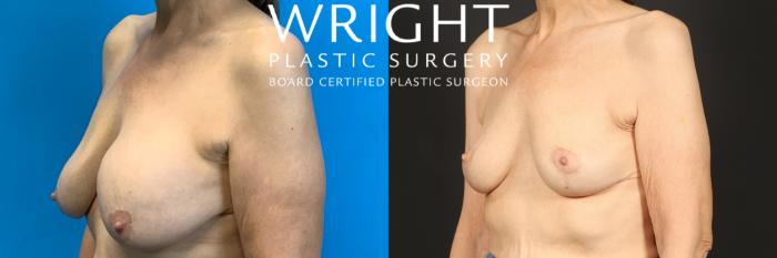 Before & After Breast Implant Removal Case 445 Left Oblique View in Little Rock, Arkansas