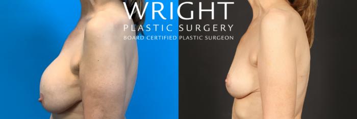 Before & After Breast Implant Removal Case 445 Left Side View in Little Rock, Arkansas