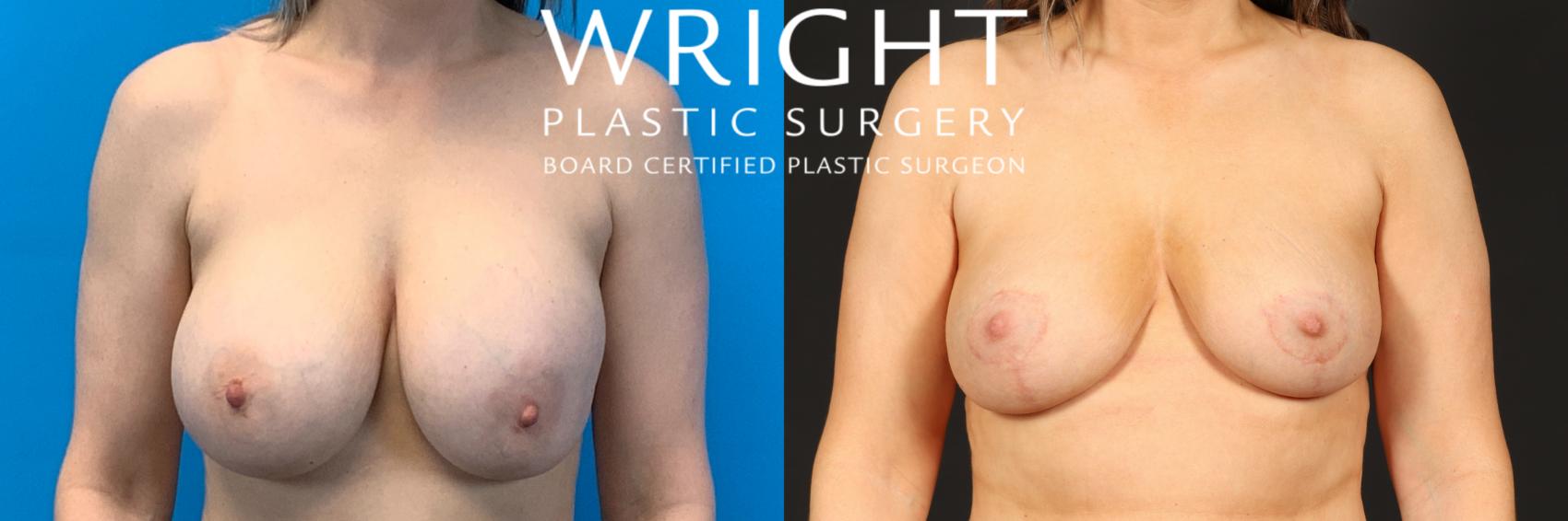 Before & After Breast Lift Case 447 Front View in Little Rock, Arkansas