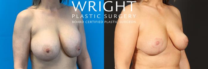 Before & After Breast Lift Case 447 Right Oblique View in Little Rock, Arkansas