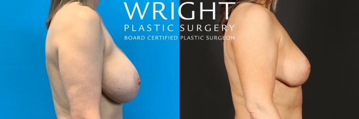 Before & After Breast Implant Removal Case 447 Right Side View in Little Rock, Arkansas