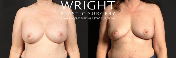 Before & After Breast Implant Removal Case 453 Front View in Little Rock, Arkansas