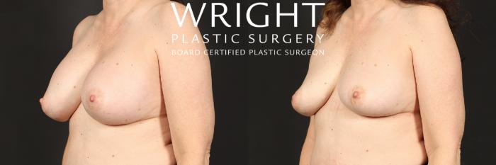 Before & After Breast Implant Removal Case 453 Left Oblique View in Little Rock, Arkansas