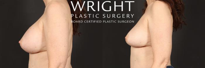 Before & After Breast Implant Removal Case 453 Left Side View in Little Rock, Arkansas