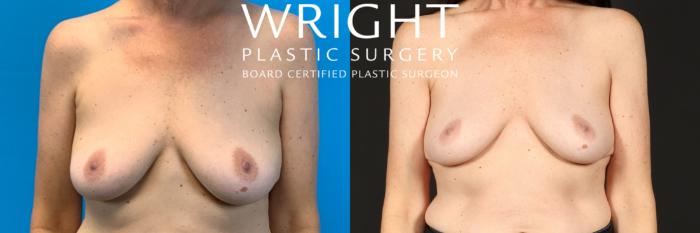 Before & After Breast Implant Removal Case 454 Front View in Little Rock, Arkansas