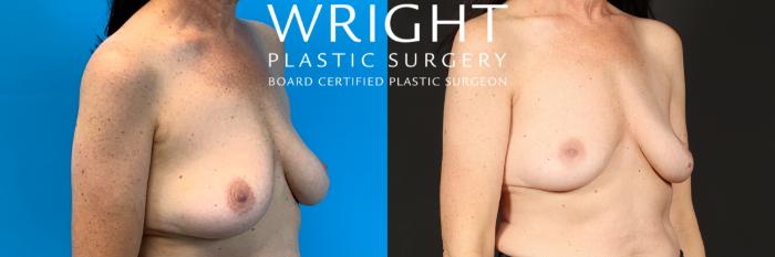 Before & After Breast Implant Removal Case 454 Right Oblique View in Little Rock, Arkansas