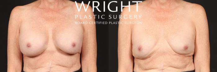 Before & After Breast Implant Removal Case 455 Front View in Little Rock, Arkansas