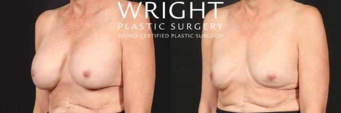 Before & After Breast Implant Removal Case 455 Left Oblique View in Little Rock, Arkansas