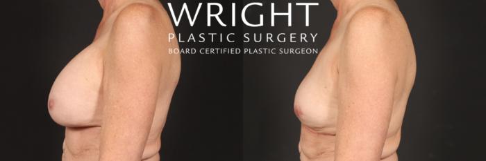 Before & After Breast Implant Removal Case 455 Left Side View in Little Rock, Arkansas