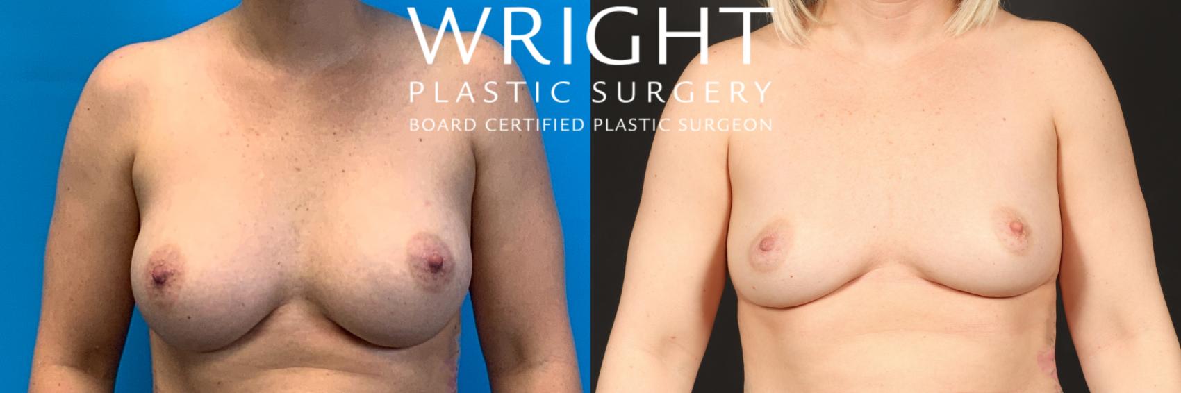 Before & After Breast Implant Removal Case 462 Front View in Little Rock, Arkansas