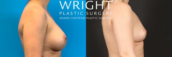 Before & After Breast Implant Removal Case 462 Left Side View in Little Rock, Arkansas