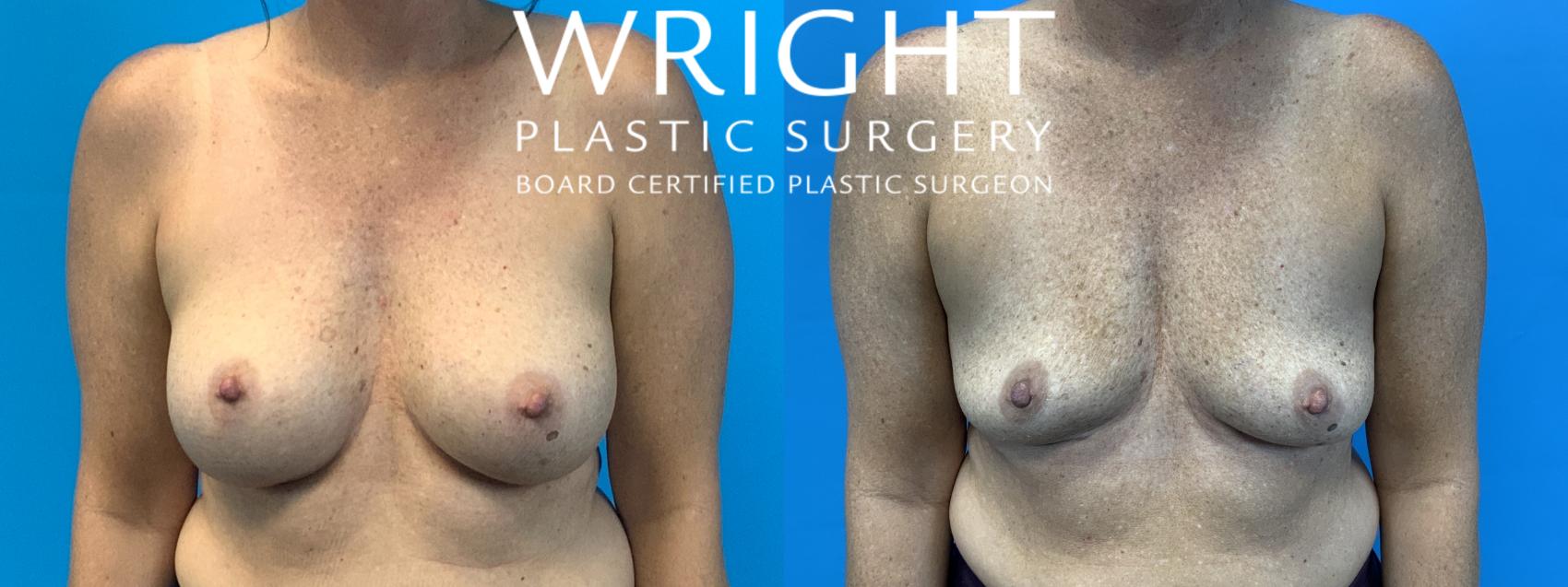 Before & After Breast Implant Removal Case 467 Front View in Little Rock, Arkansas