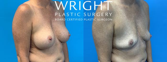 Before & After Breast Implant Removal Case 467 Right Oblique View in Little Rock, Arkansas