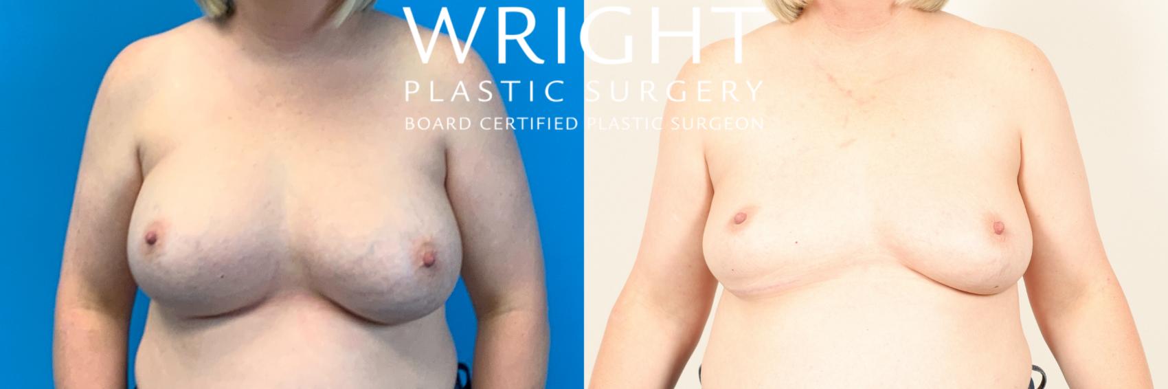 Before & After Breast Implant Removal Case 475 Front View in Little Rock, Arkansas