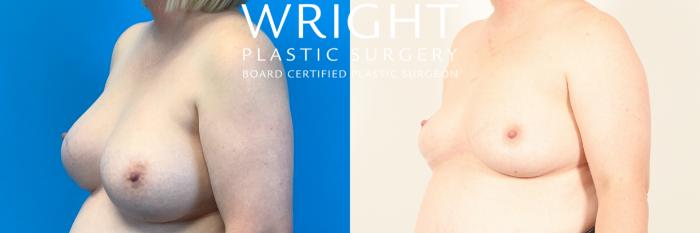 Before & After Breast Implant Removal Case 475 Left Oblique View in Little Rock, Arkansas