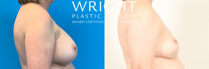 Before & After Breast Implant Removal Case 475 Right Side View in Little Rock, Arkansas