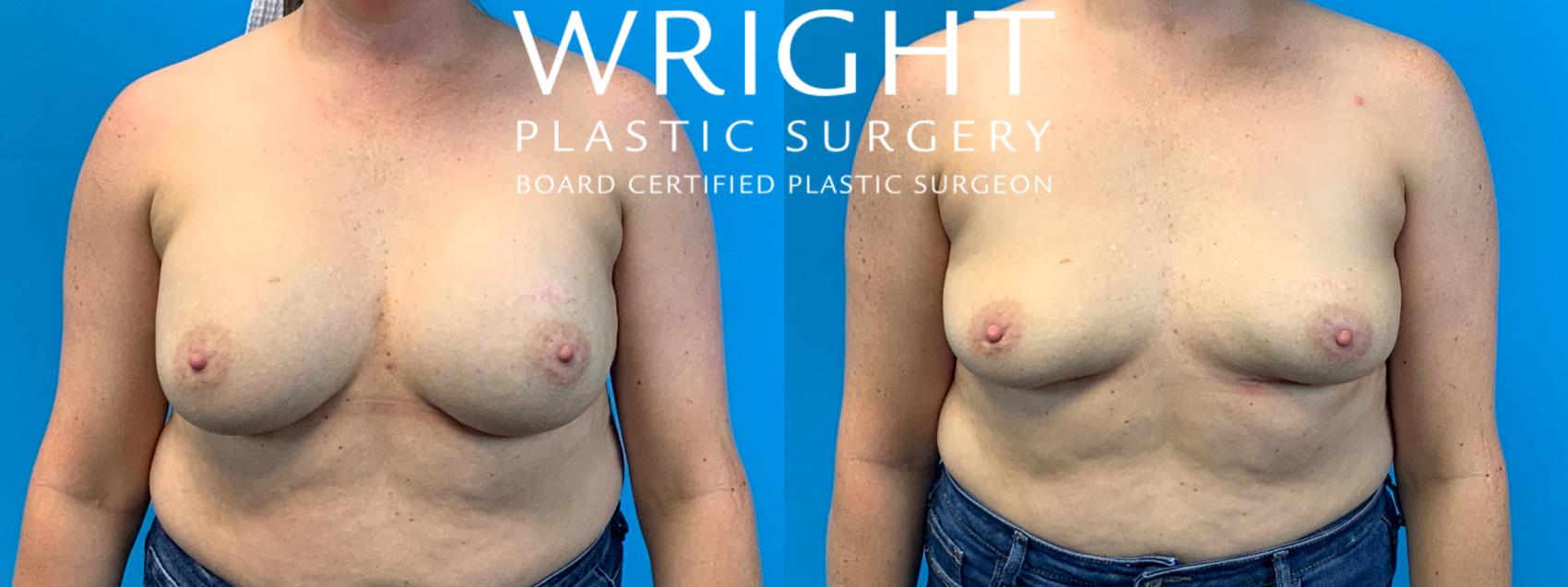 Before & After Breast Implant Removal Case 476 Front View in Little Rock, Arkansas