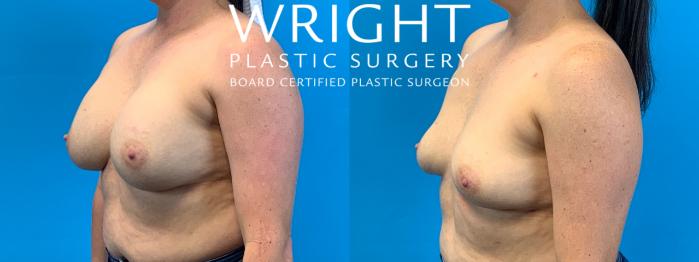 Before & After Breast Implant Removal Case 476 Left Oblique View in Little Rock, Arkansas