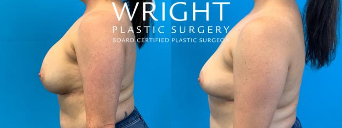 Before & After Breast Implant Removal Case 476 Left Side View in Little Rock, Arkansas