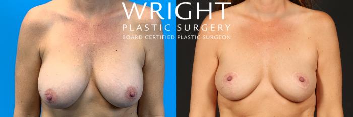 Before & After Breast Lift Case 481 Front View in Little Rock, Arkansas