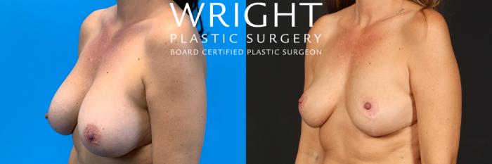 Before & After Breast Lift Case 481 Left Oblique View in Little Rock, Arkansas