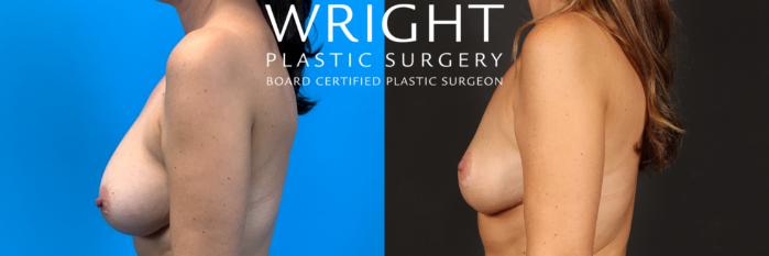 Before & After Breast Lift Case 481 Left Side View in Little Rock, Arkansas