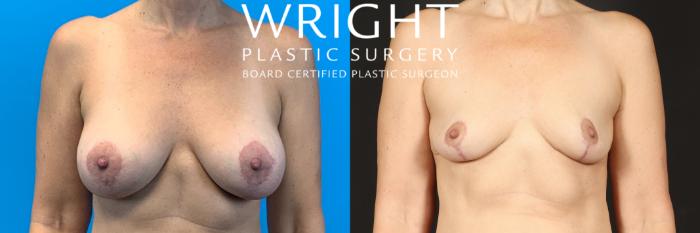 Before & After Breast Implant Removal Case 489 Front View in Little Rock, Arkansas