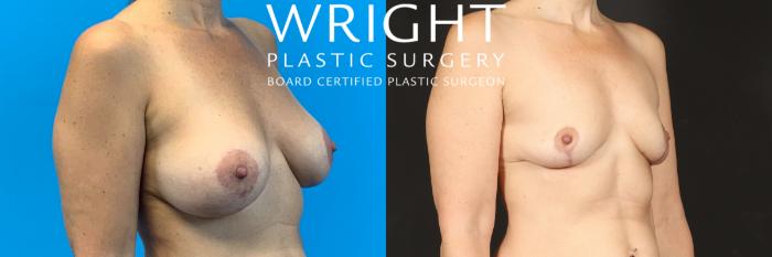 Before & After Breast Implant Removal Case 489 Right Oblique View in Little Rock, Arkansas