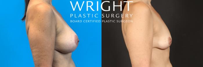 Before & After Breast Implant Removal Case 489 Right Side View in Little Rock, Arkansas