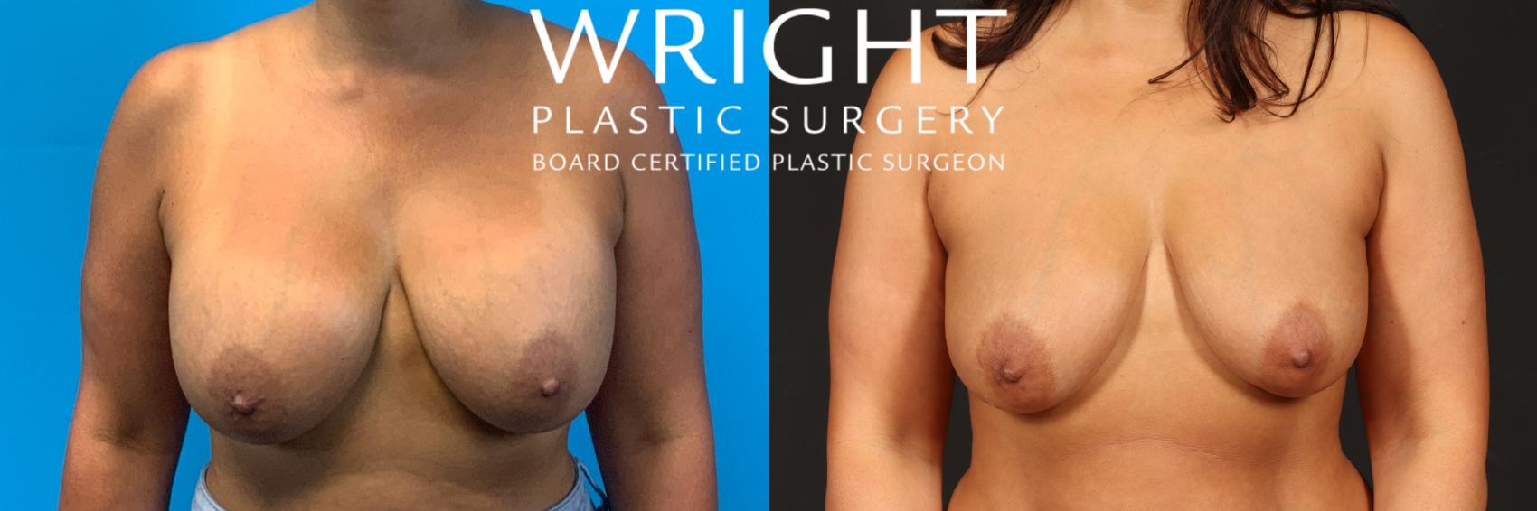 Before & After Breast Implant Removal Case 492 Front View in Little Rock, Arkansas