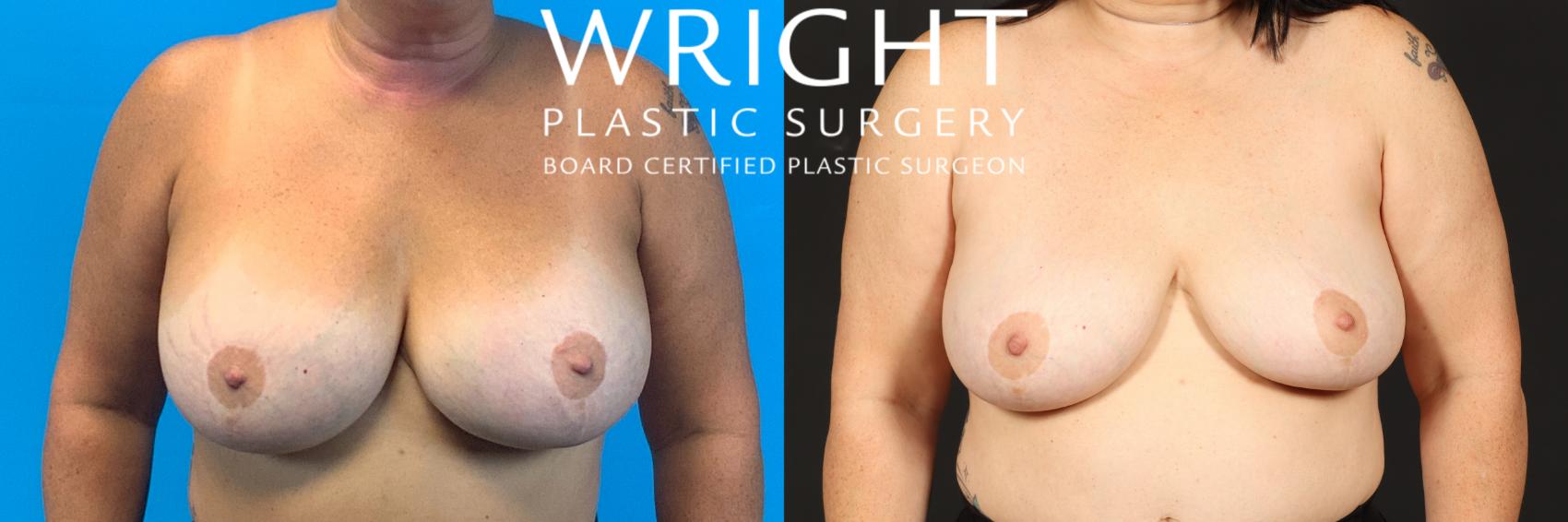 Before & After Breast Implant Removal Case 498 Front View in Little Rock, Arkansas