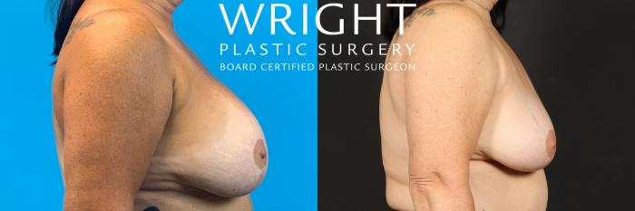 Before & After Breast Implant Removal Case 498 Right Side View in Little Rock, Arkansas