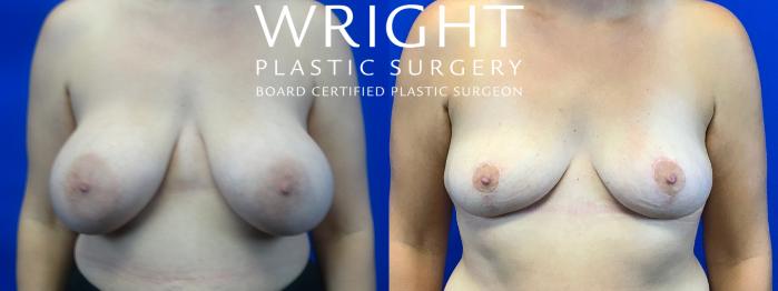 Before & After Breast Implant Removal Case 50 Front View in Little Rock, Arkansas