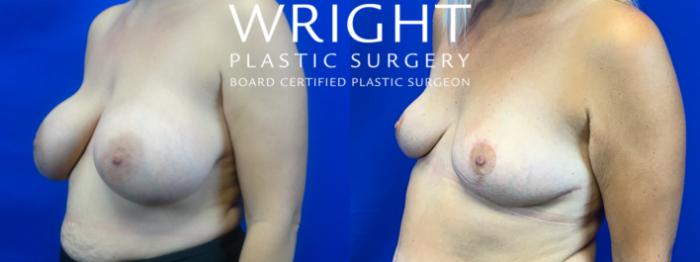 Before & After Breast Lift Case 50 Left Oblique View in Little Rock, Arkansas