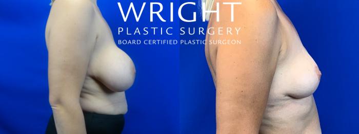 Before & After Breast Lift Case 50 Right Side View in Little Rock, Arkansas