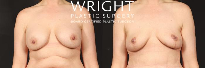 Before & After Breast Implant Removal Case 501 Front View in Little Rock, Arkansas