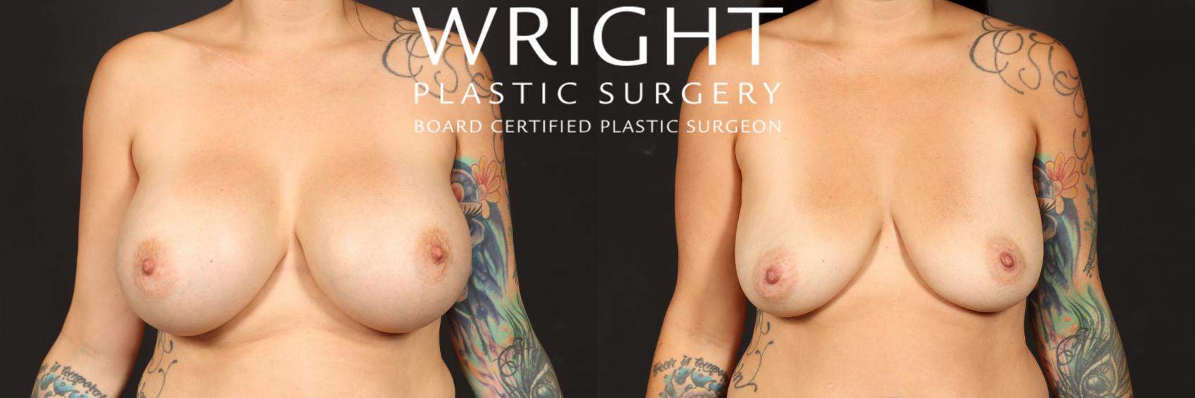 Before & After Breast Implant Removal Case 506 Front View in Little Rock, Arkansas