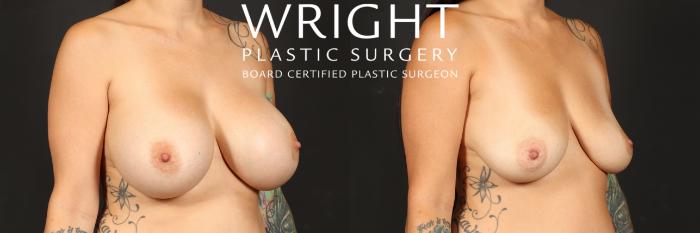 Before & After Breast Implant Removal Case 506 Right Oblique View in Little Rock, Arkansas