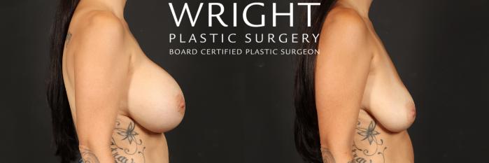 Before & After Breast Implant Removal Case 506 Right Side View in Little Rock, Arkansas