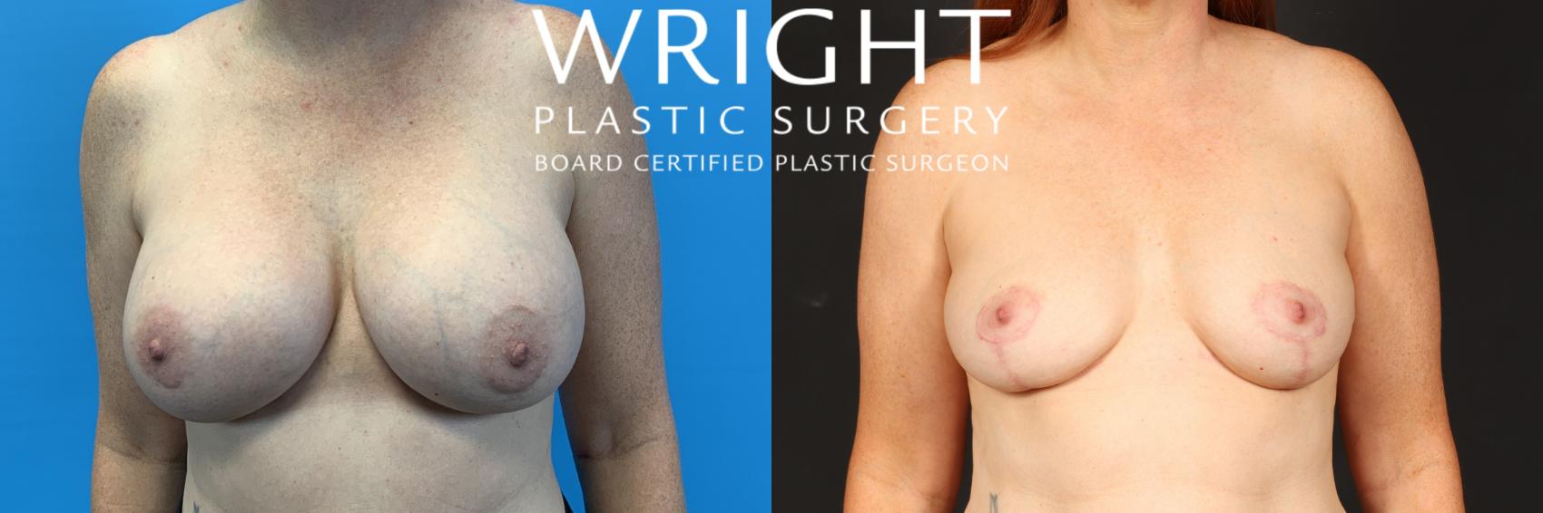 Before & After Breast Implant Removal Case 512 Front View in Little Rock, Arkansas