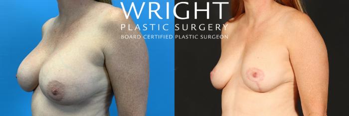 Before & After Breast Implant Removal Case 512 Left Oblique View in Little Rock, Arkansas