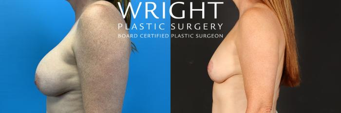 Before & After Breast Implant Removal Case 512 Left Side View in Little Rock, Arkansas