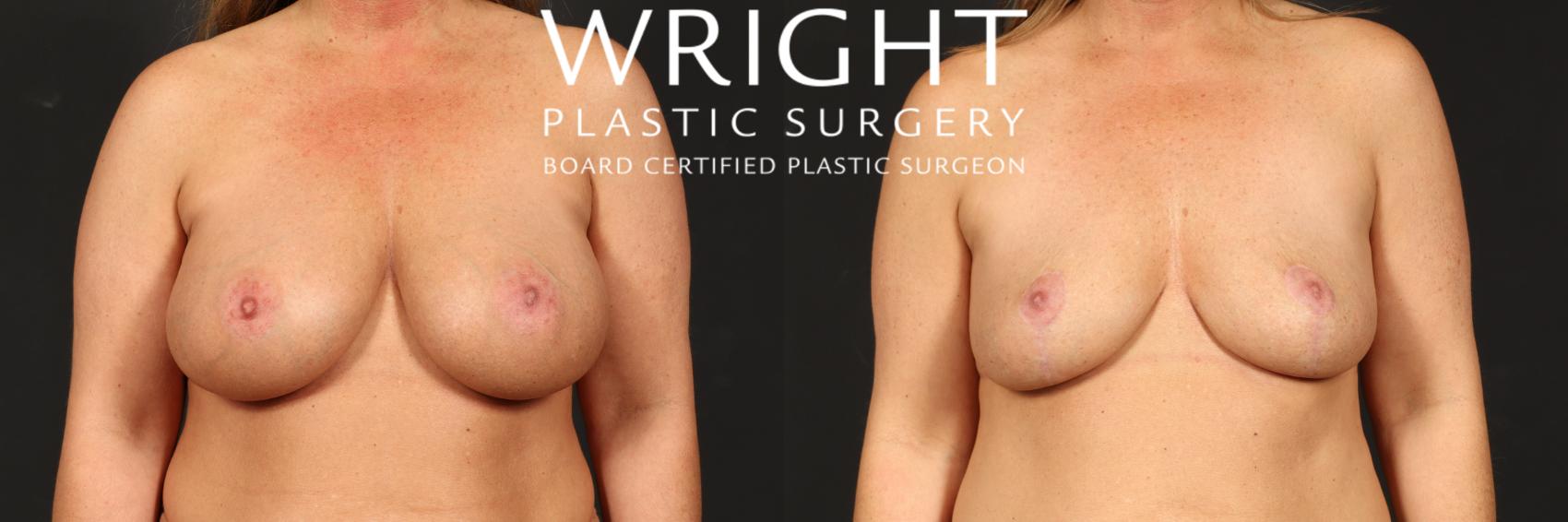 Before & After Breast Implant Removal Case 520 Front View in Little Rock, Arkansas